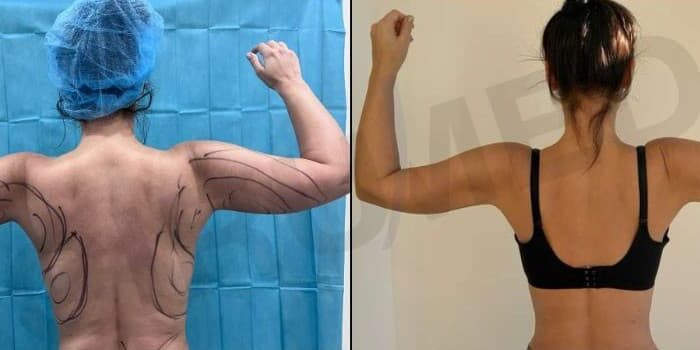 Liposuction arms J-plasma, liposuccion brazos