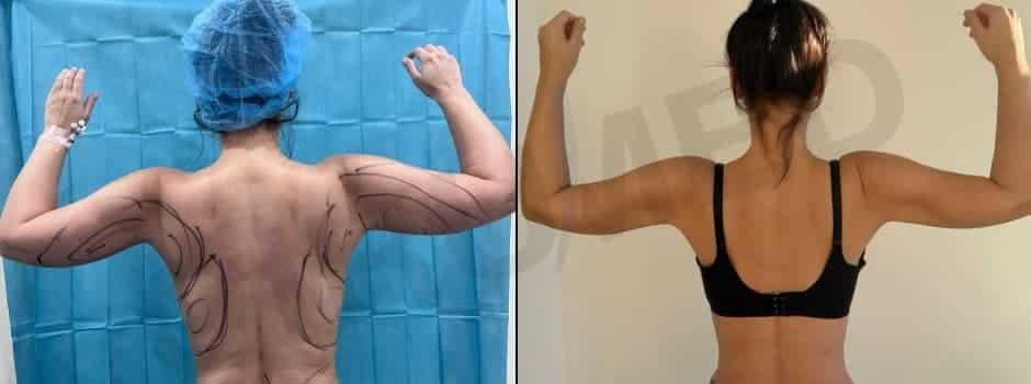 Liposucción de brazos asistida con J-Plasma para retracción cutánea