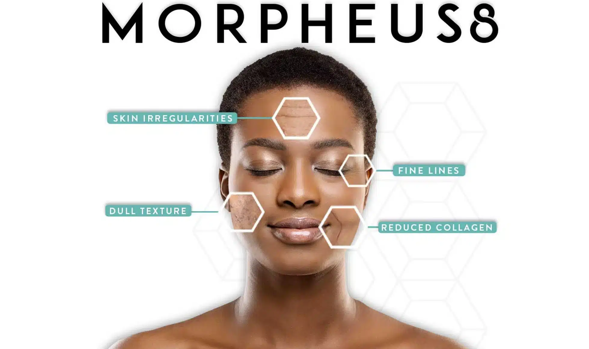 Morpheus8: radiofrecuencia fraccionada con microagujas