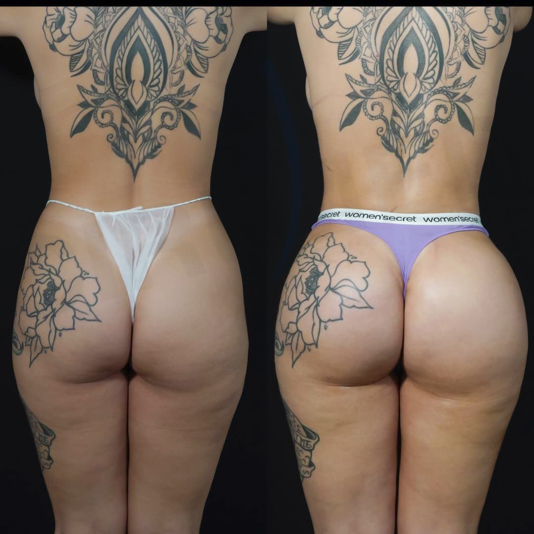 Antes y después de un caso clínico de cirugía estética