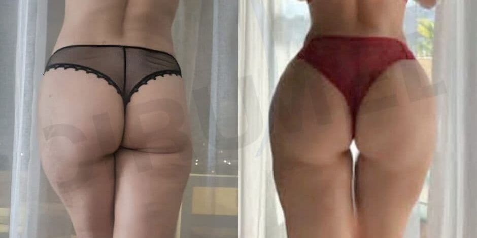 Brazilain butt lift with rib remodelling