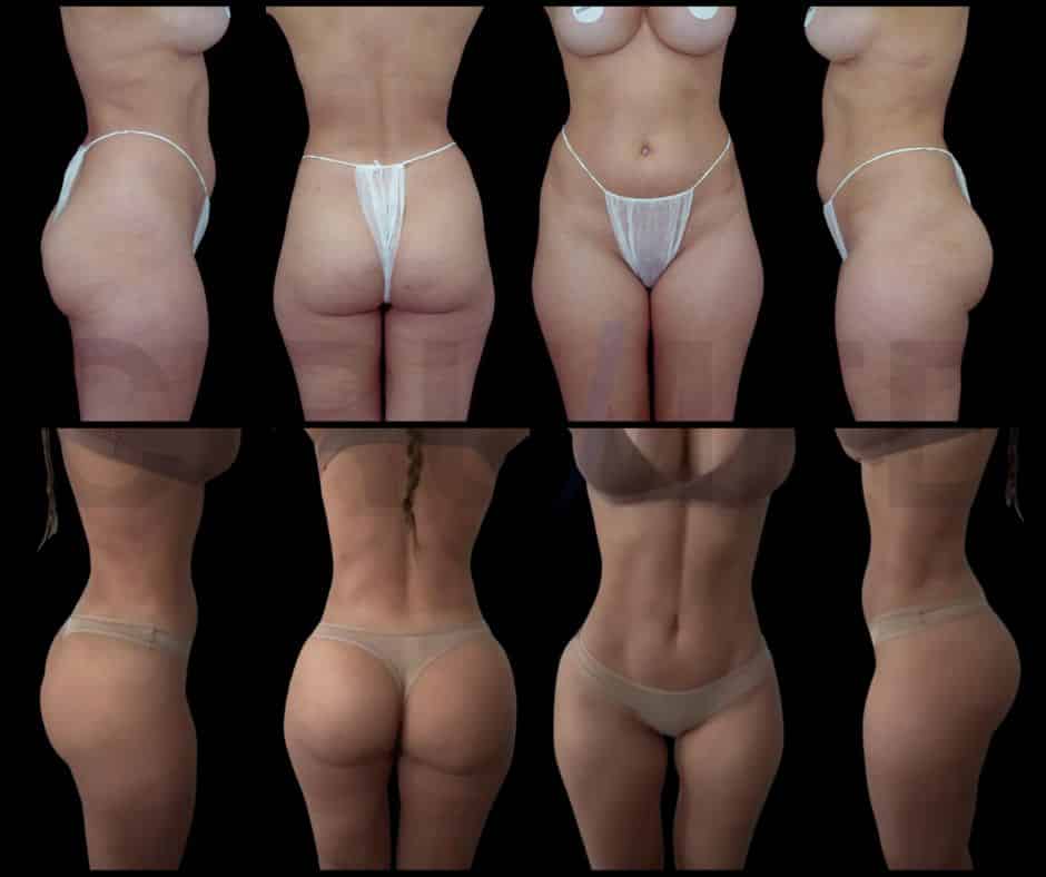 Rib modeling antes y después: cintura más definida en zona superior