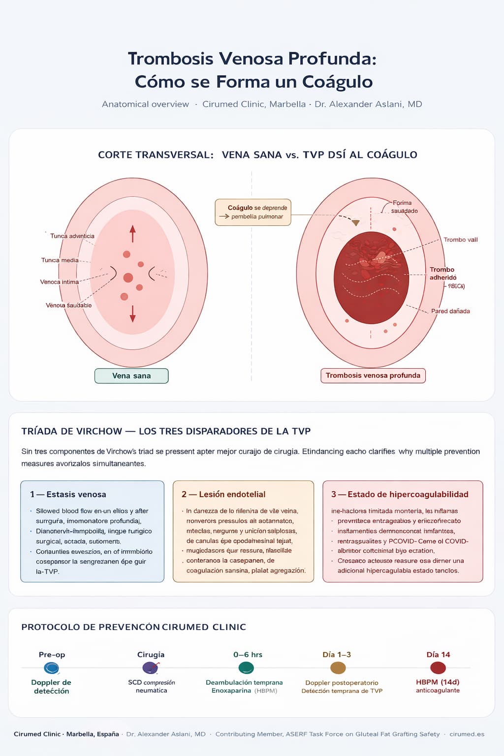 Trombosis venosa profunda cómo se produce