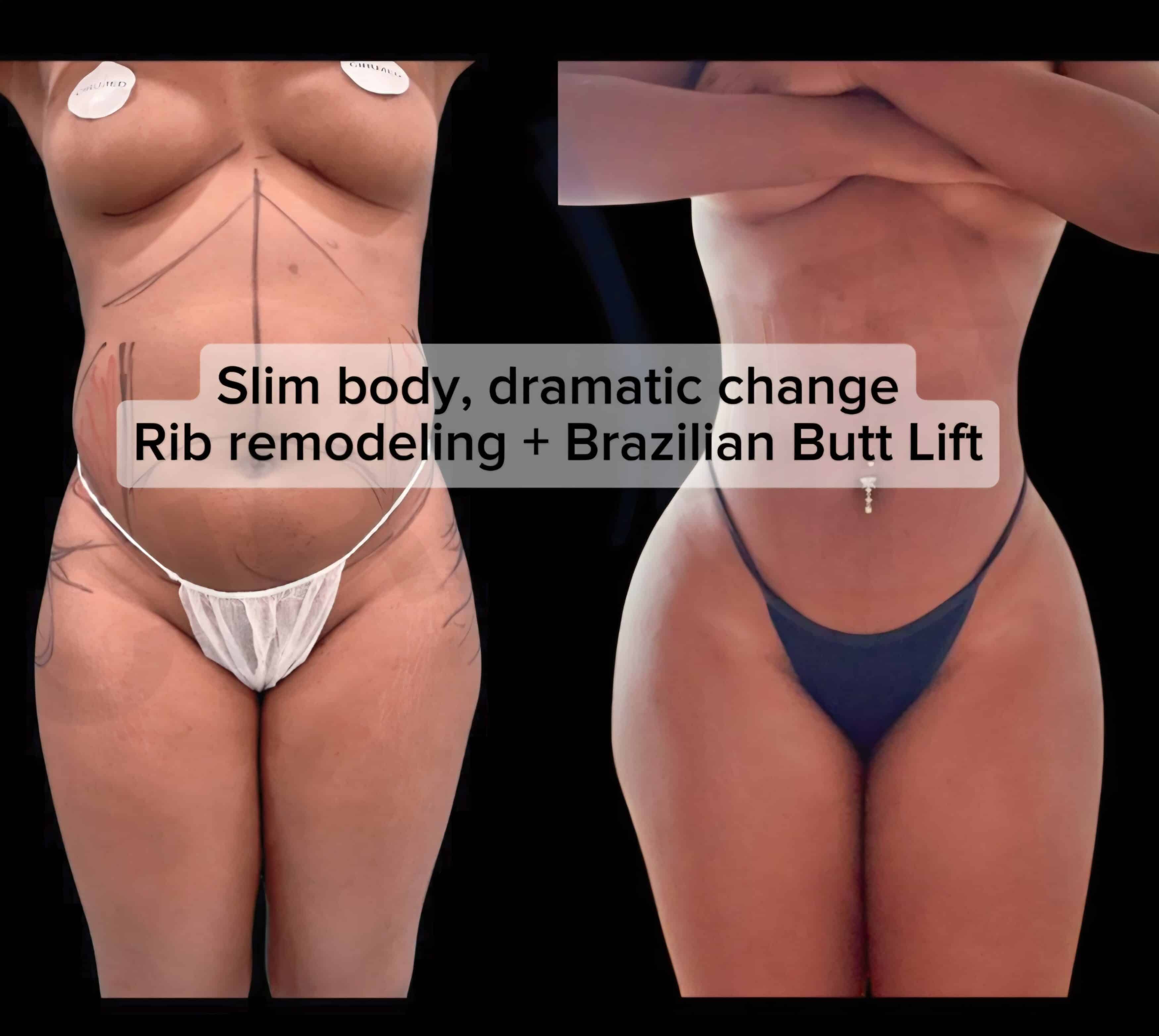 Remodelación costal y Brazilian Butt Lift de reloj de arena — Cirumed Clinic Marbella