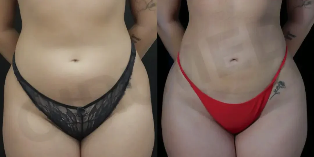 Bikini makeover surgery breast augmentation with 360 liposuction front view