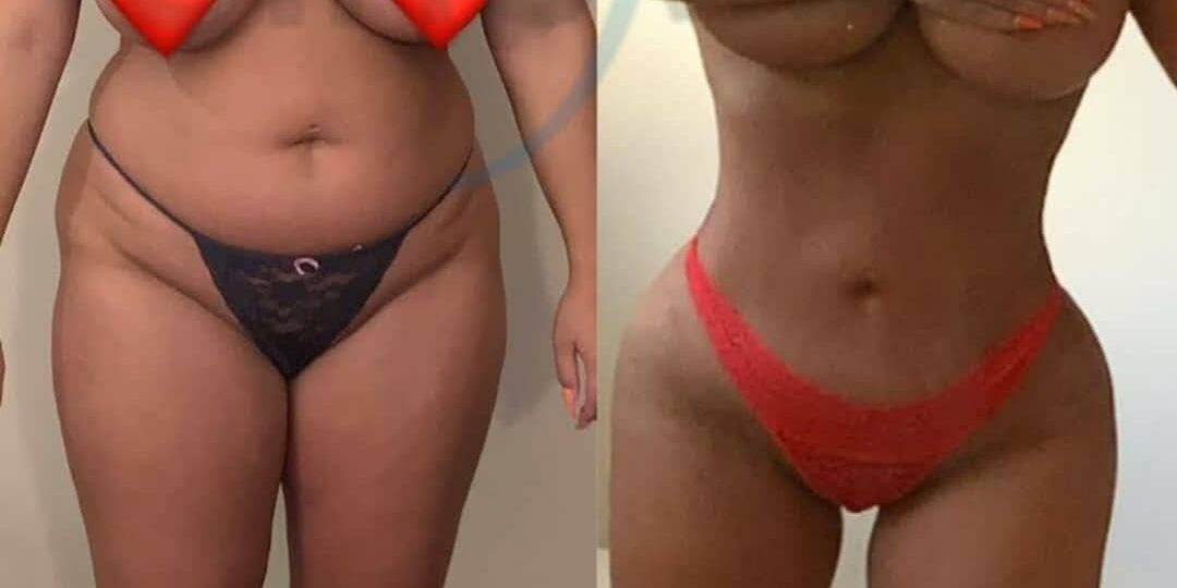 Brazilian butt lift high definition waist front view