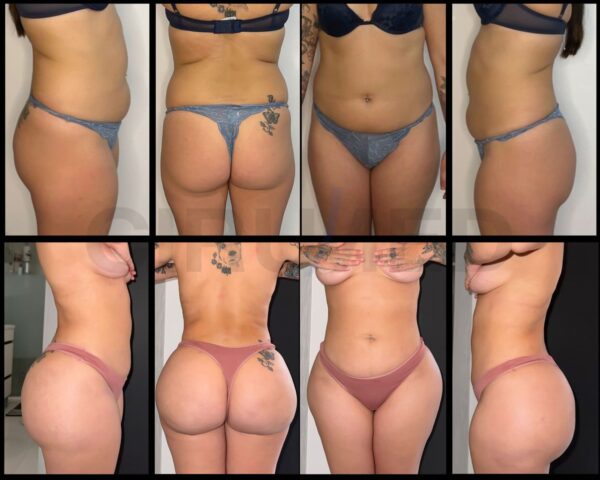 Brazilian butt lift long-run outcome