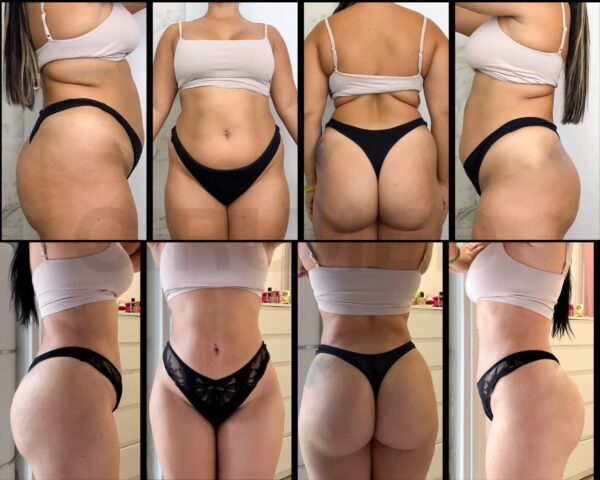 Brazilian butt lift long term result