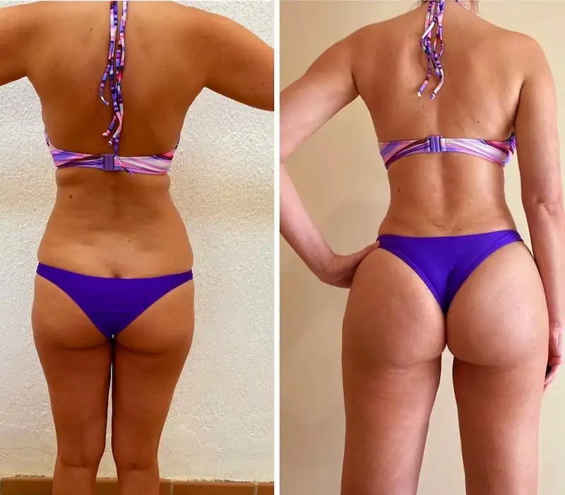 Brazilian Butt Lift en una ronda Dr Aslani Cirumed Marbella
