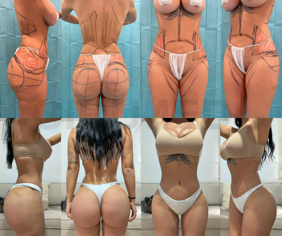 Caso de revisión de Brazilian Butt Lift con implantes Dr Aslani Marbella