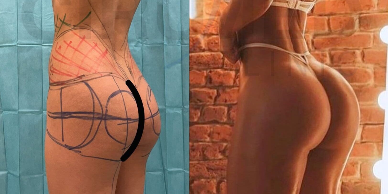 Buttock augmentation enhancement implants