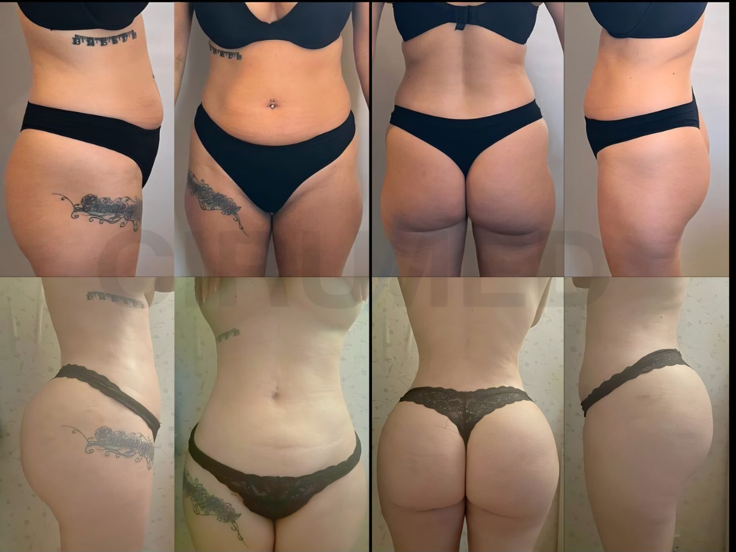 Doble BBL resultado estable a largo plazo — Cirumed Clinic Marbella