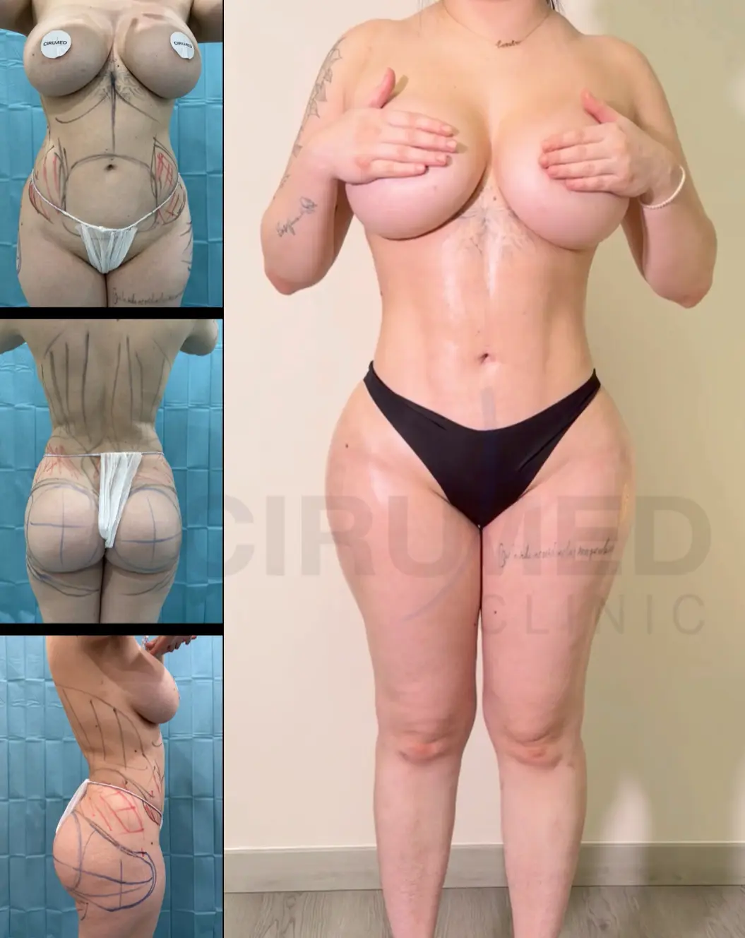 Before and after a body transformation with an hourglass shape and balanced proportion between hips and legs