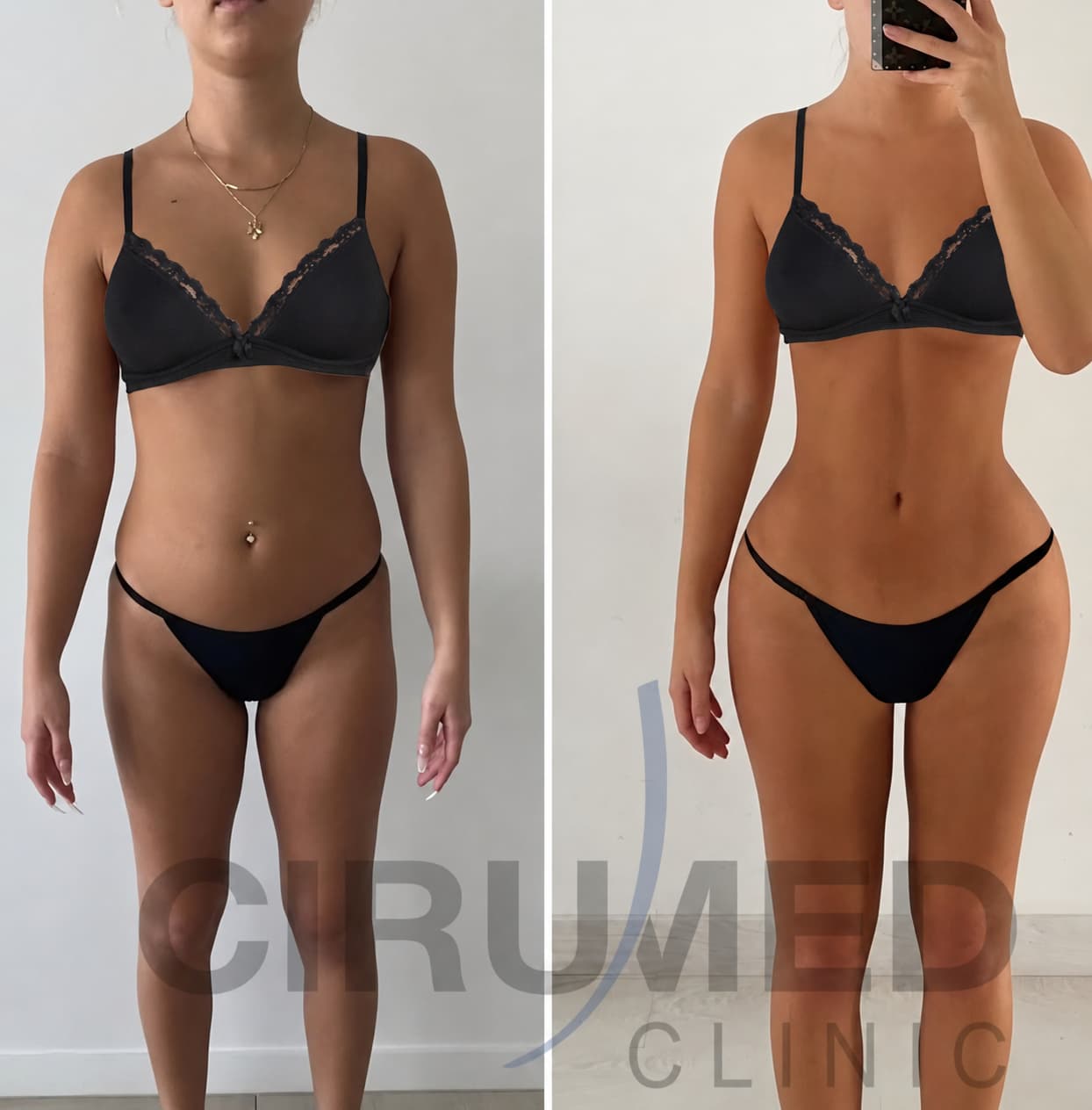 expansión anterior caderas BBL 360 Supercharged reloj de arena Dr. Aslani Cirumed Marbella