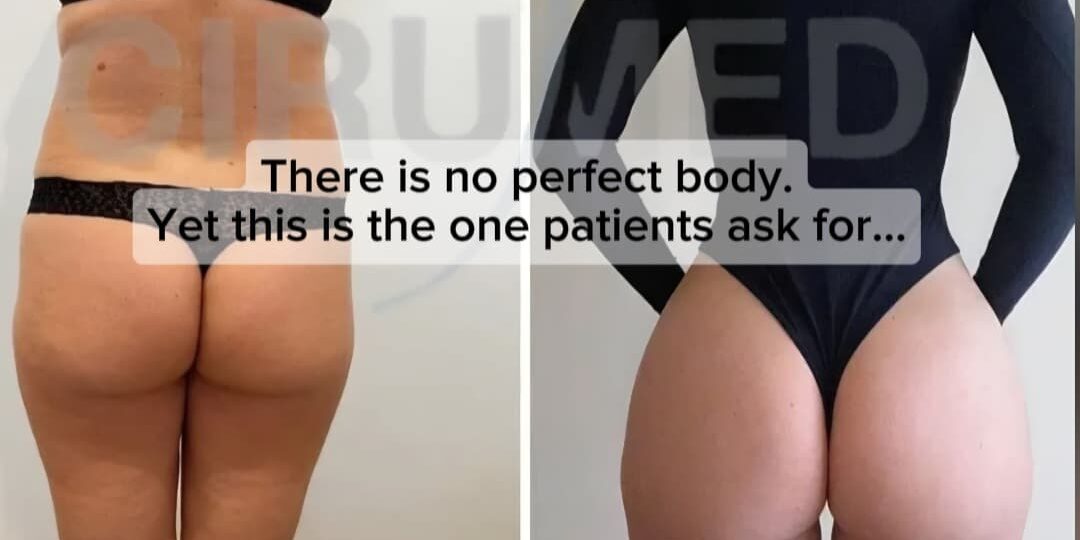 Antes y después BBL aumento de glúteos resultado natural cirugía estética