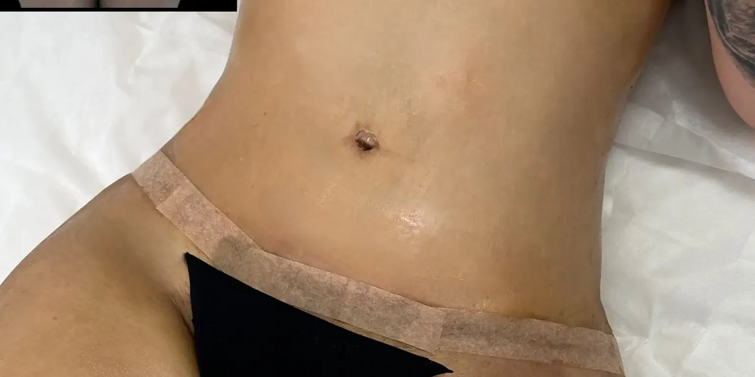 Abdominoplasty Scar Lower