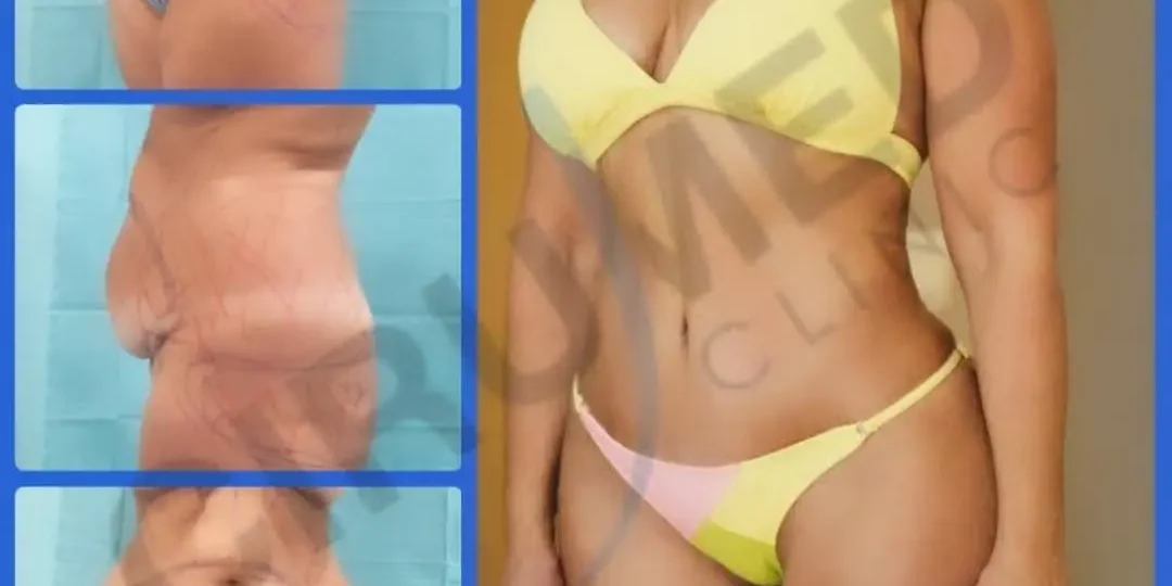 abdominoplasty (tummy tuck)