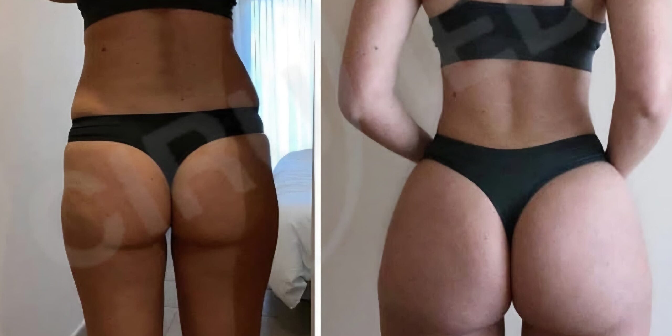 brazilian butt lift fat transfer only no implants