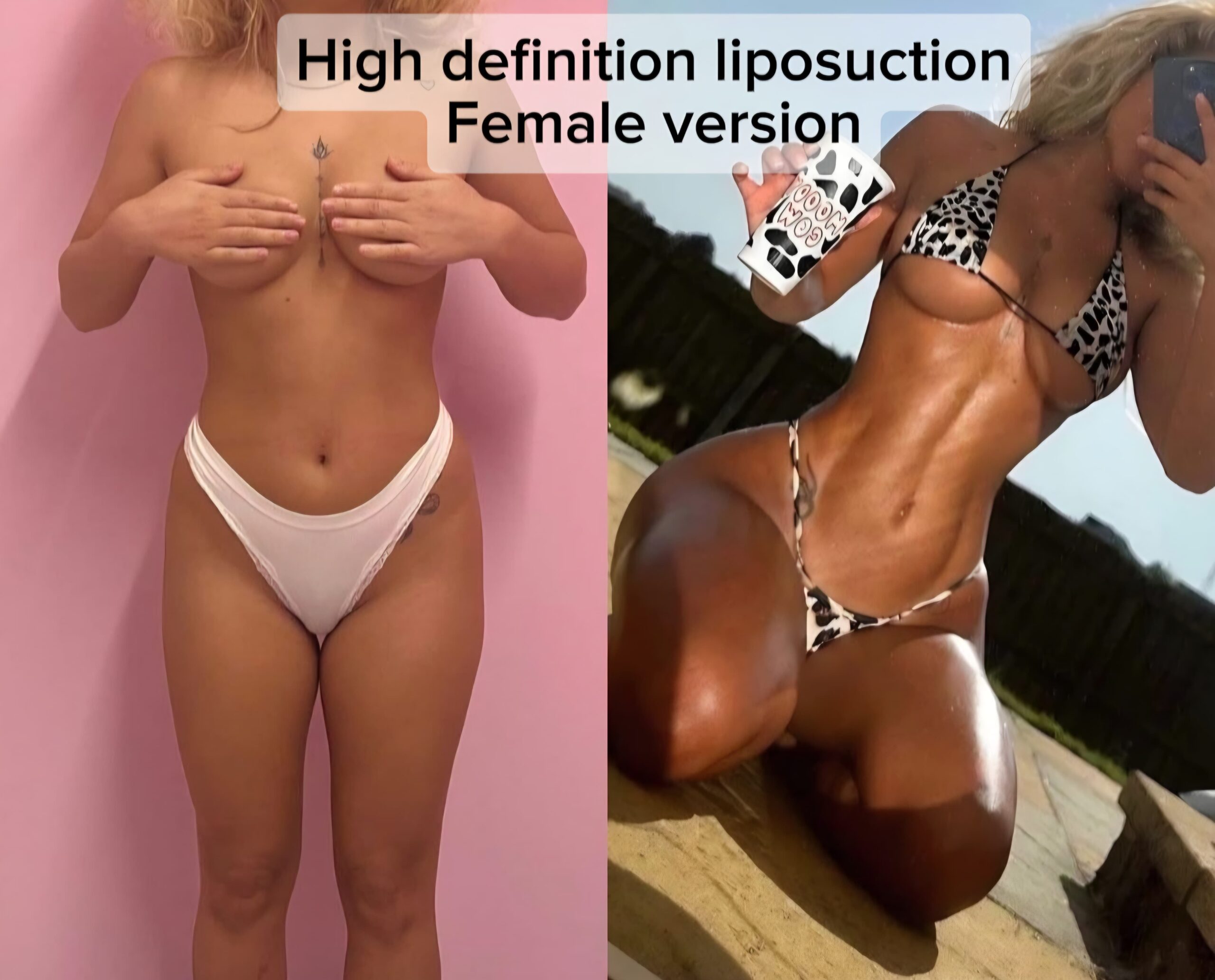 Resultado de liposucción de alta definición femenina — definición abdominal atlética sin masculinización, Dr. Aslani Cirumed Marbella