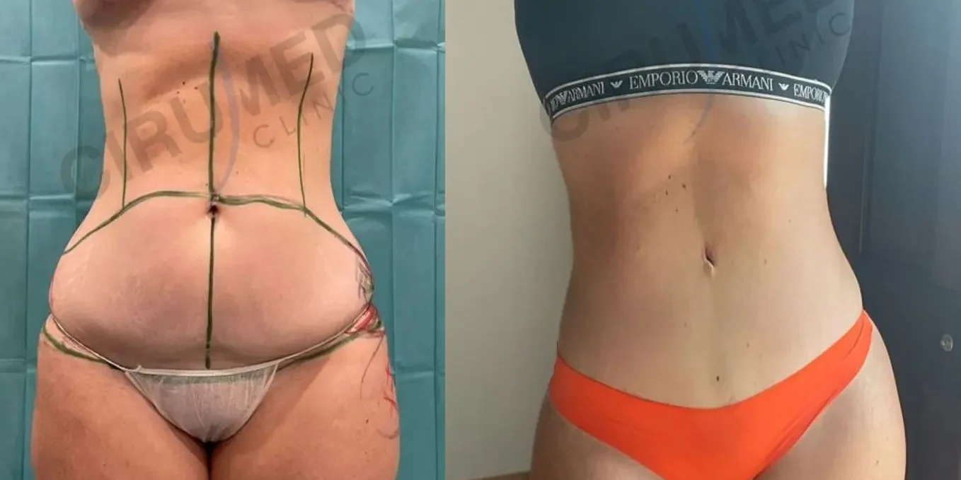 mommy makeover tummy tuck and bbl dr aslani marbella