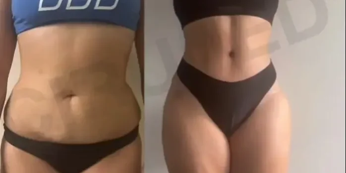 tummy tuck frente
