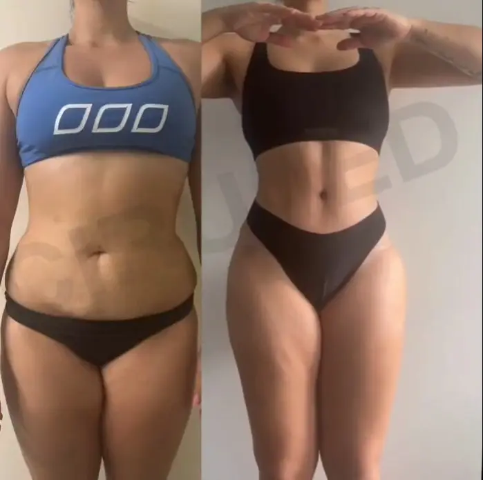 Abdominoplastia resultado vista frontal — Cirumed Clinic Marbella Dr. Aslani