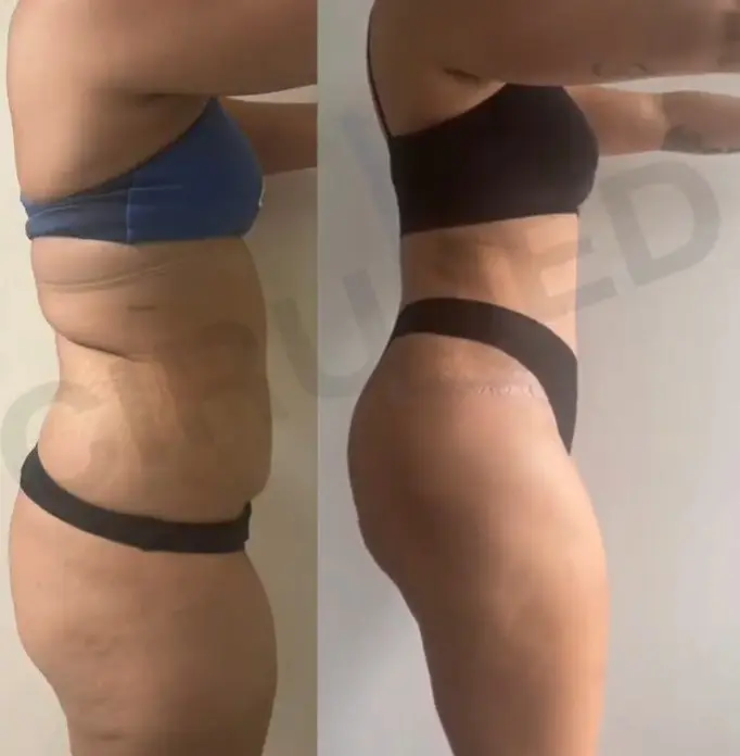Abdominoplastia resultado vista de perfil — Cirumed Clinic Marbella Dr. Aslani